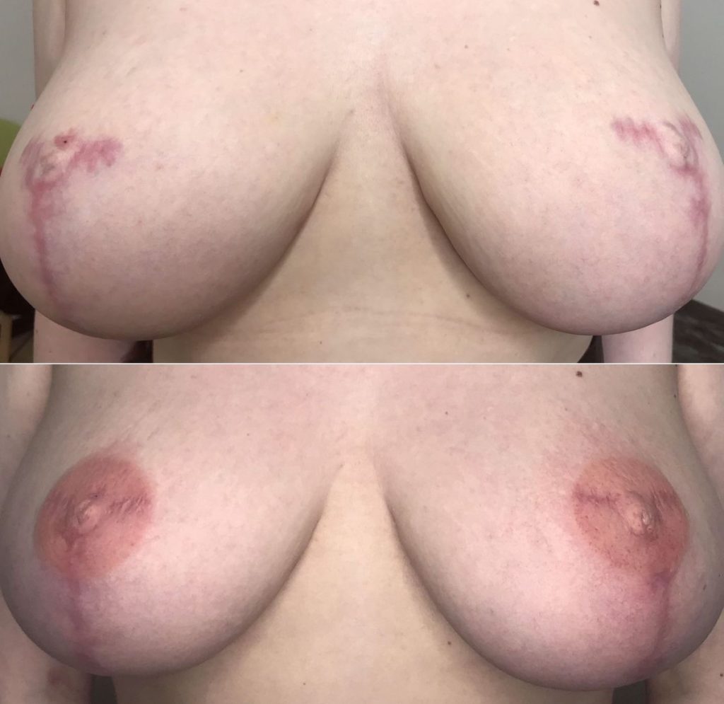 ореолы на грудях у женщин (120) фото